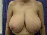 breast reduction, mammaplasty